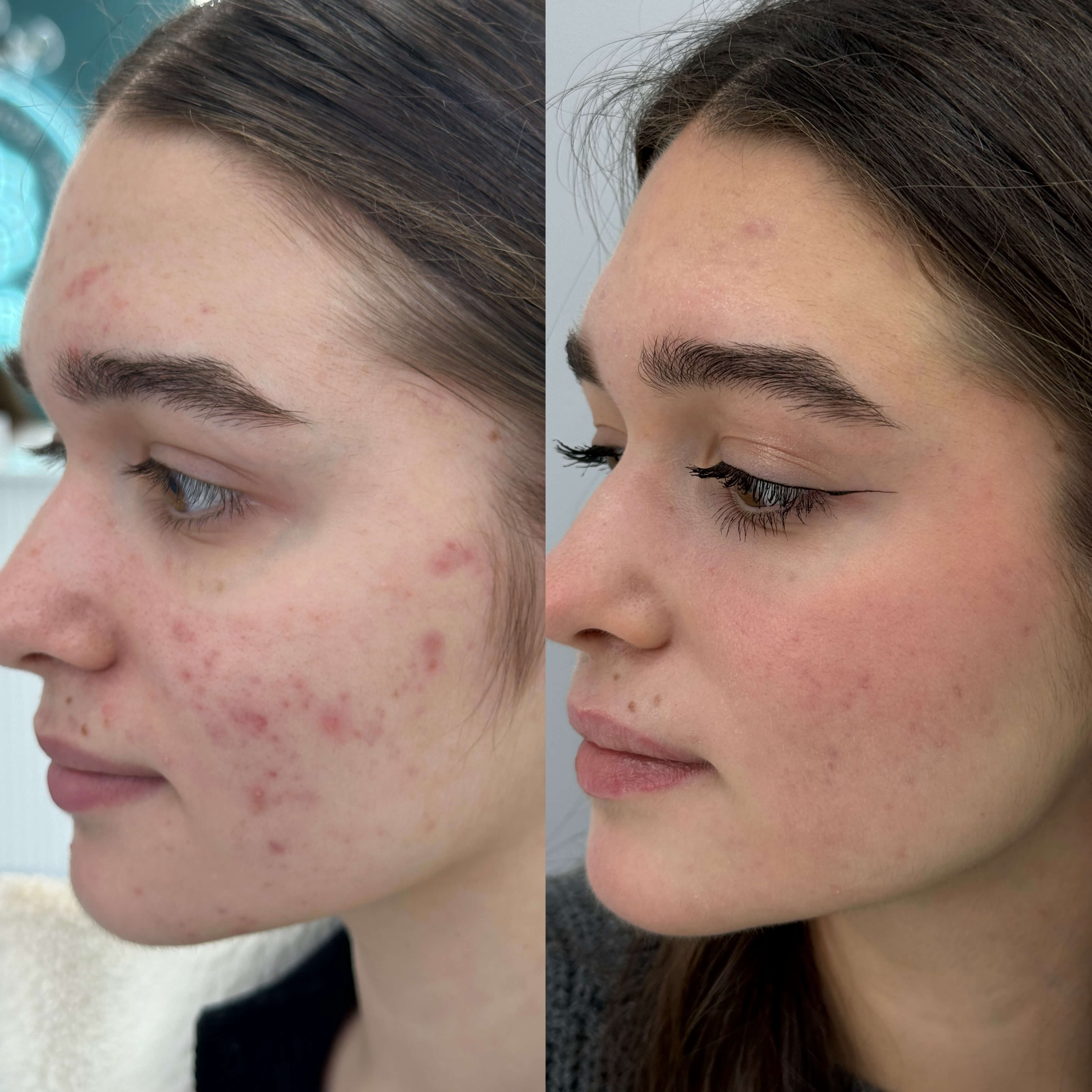 Результат Лечение акне 6