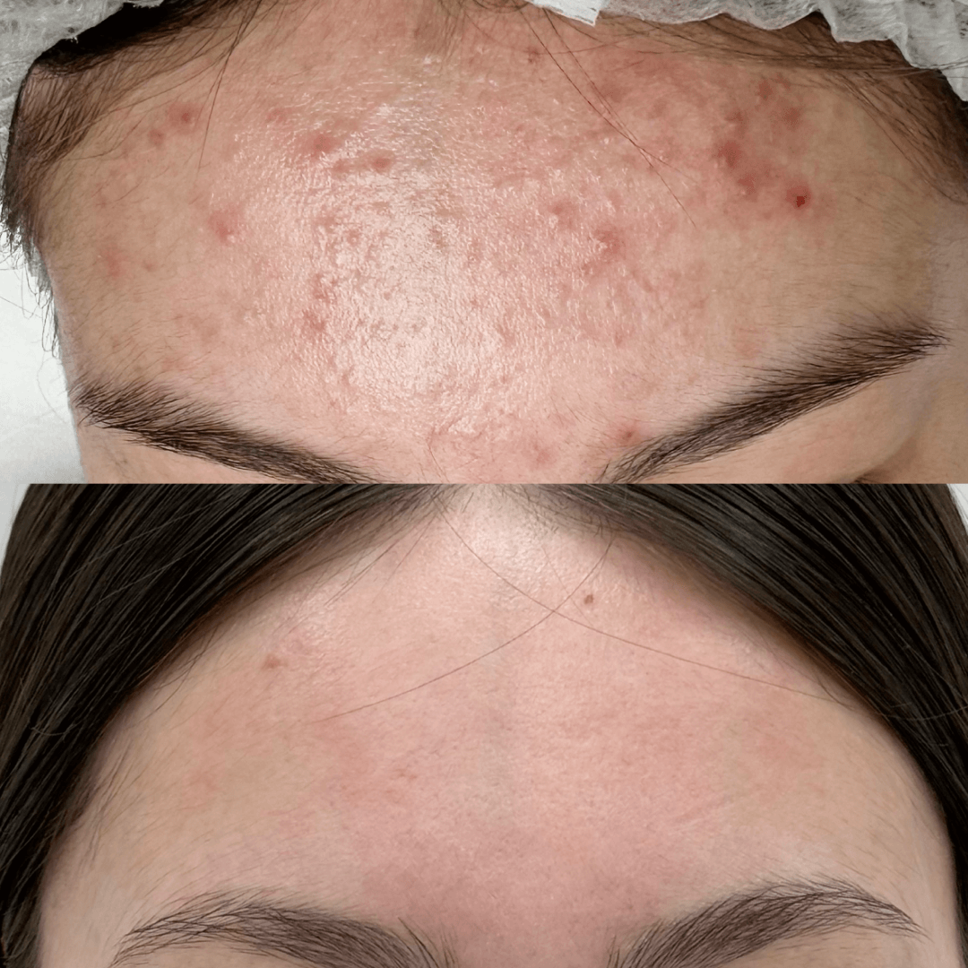 Результат Лечение акне 5